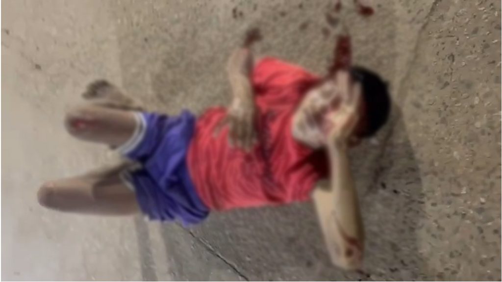 Warau man critical after hit and run at Mabaruma